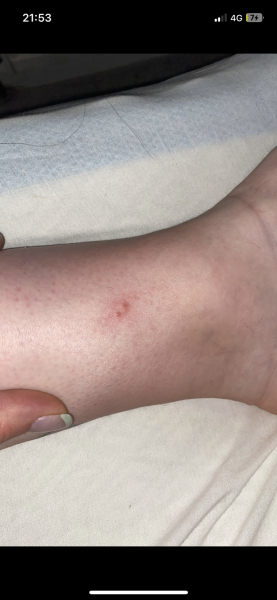 To think these are chicken pox?