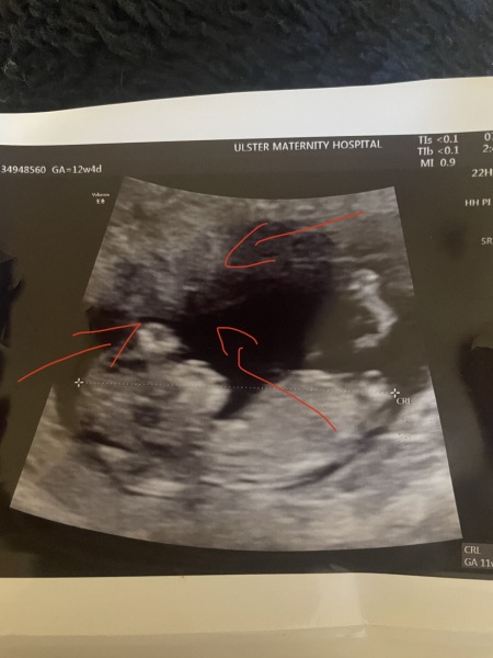 Worried about 12 week scan pictures