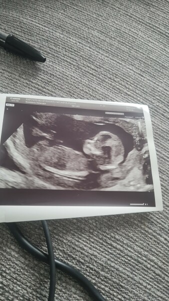 Help! Can anyone see a nub - 13 week scan