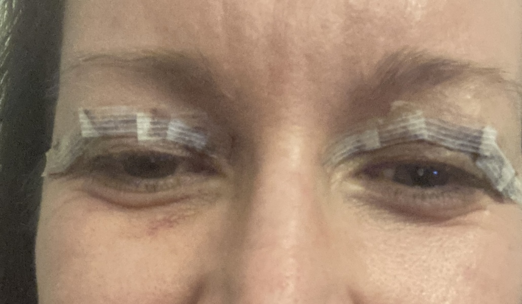 Upper Blepheroplasty