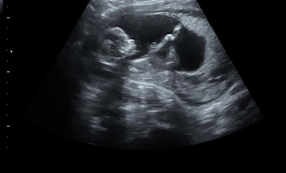Gender of baby 