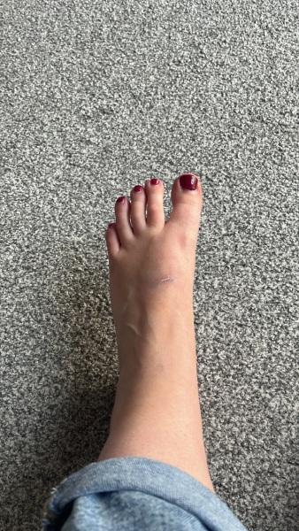 Dropped chopping board on foot - please tell me a break isn't likely