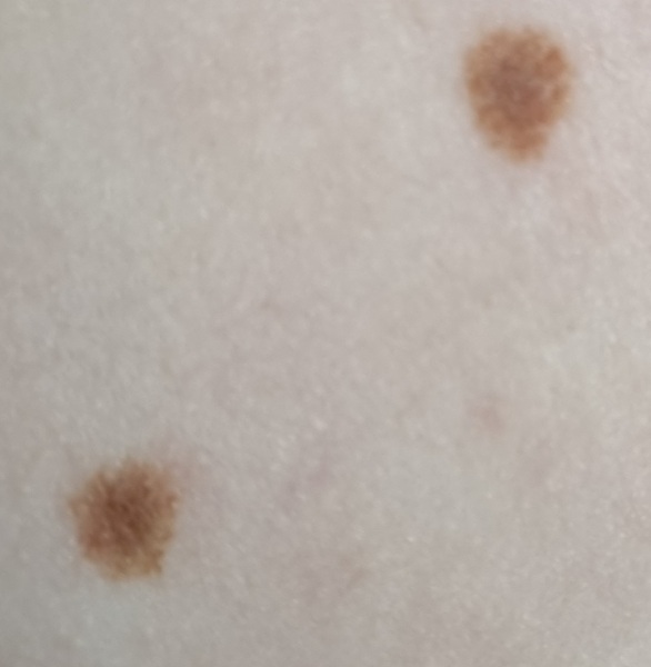 Does DDs mole need to be checked?