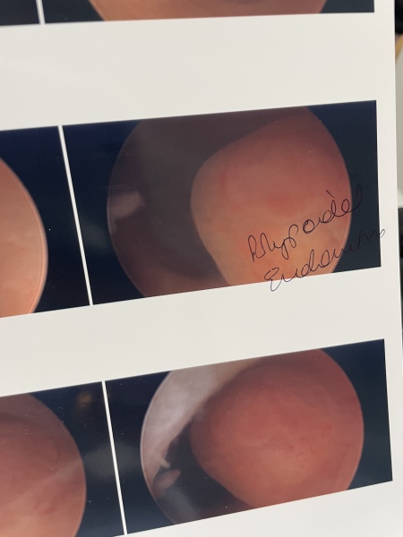 Can anyone read this doctors handwriting after hysteroscopy.!? 