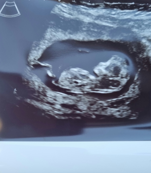 12 week scan nerves