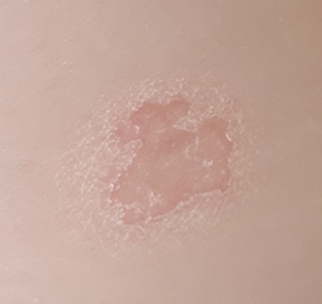 Is this psoriasis?