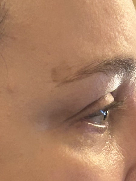 Is this a melanoma?