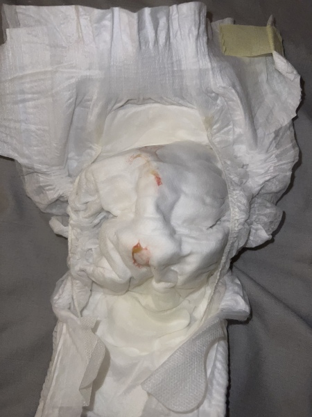 Mucus with blood and no poo