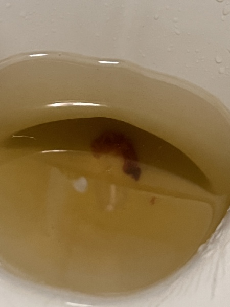 Tw- Is this an early miscarriage. Pic attached 