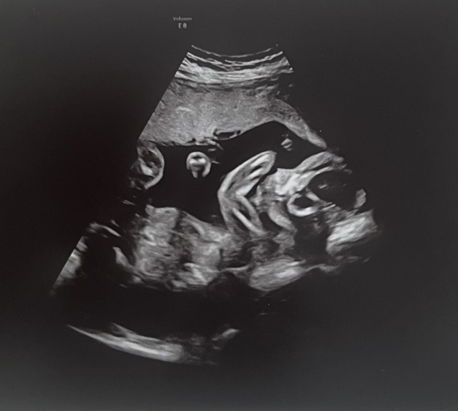 What do you think baby is from 20 week scan