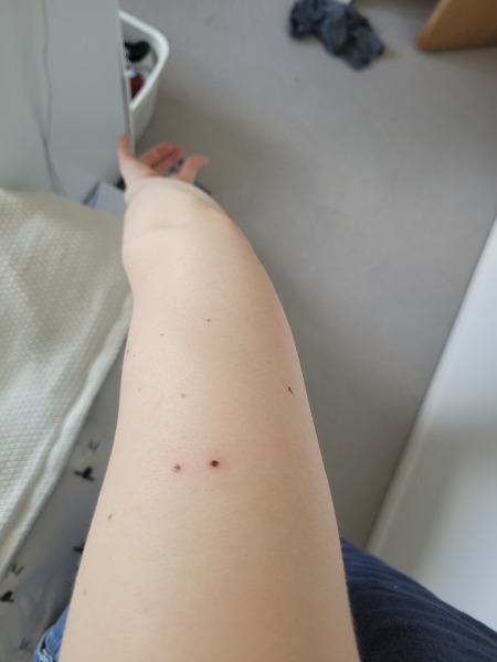 Any GPs around...odd new moles...