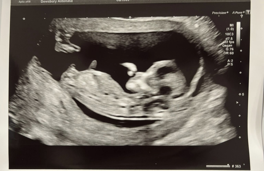 12 week scan, NT measurement