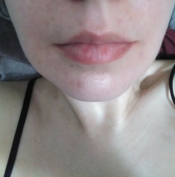 Lip fillers?