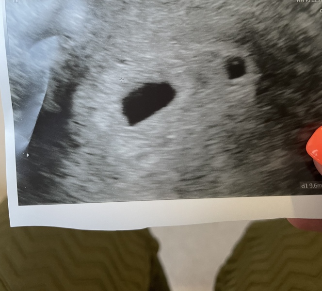 Twin pregnancy or not???? Thought????
