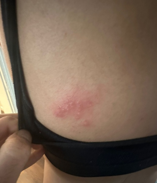 Severe body itching since 13 weeks pregnant 
