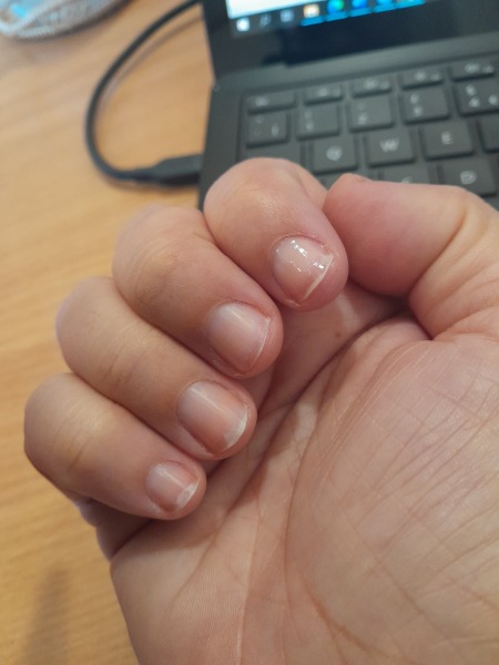 Why are my nails peeling?! 