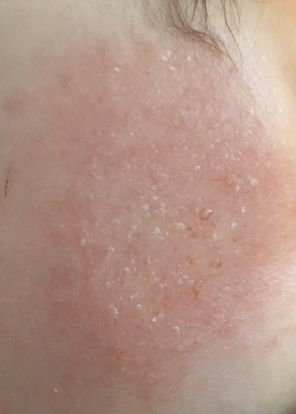 Baby's eczema weeping help pls