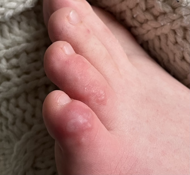 DS’s toe is agony, what can we do? (Includes toe photo)