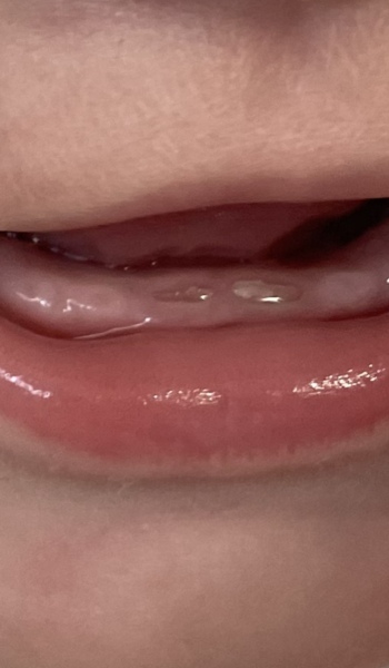 Concerned about baby teeth (pic)