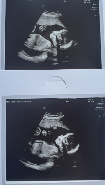 What do you think baby is from 20 week scan