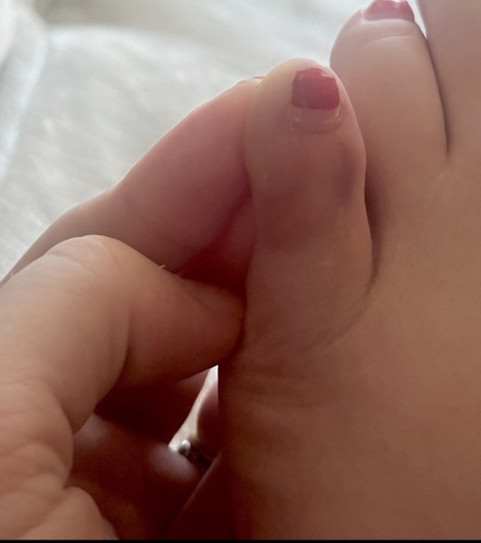Is my toe broken?