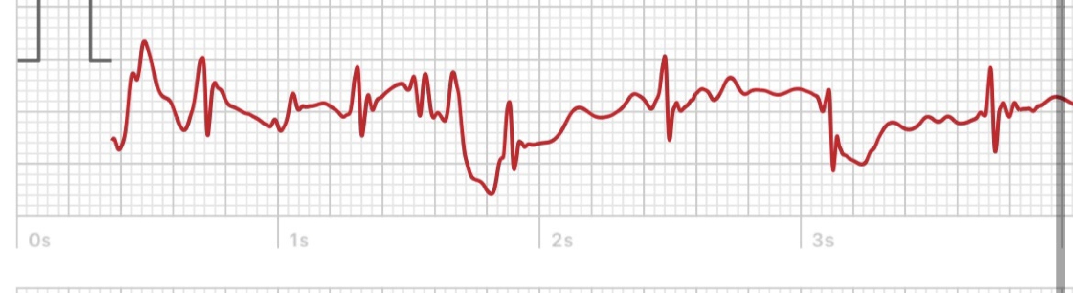 Is this ecg normal ?