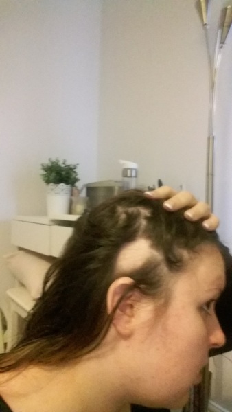 Bald patch appeared on top of head 