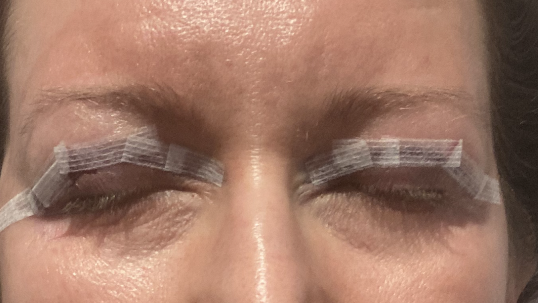 Upper Blepheroplasty