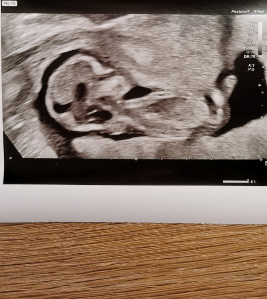 Face down ultrasound - first baby