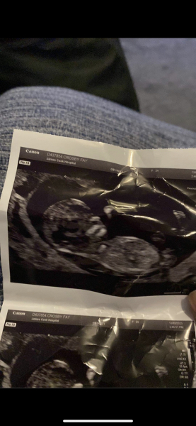 12 week scan, NT measurement