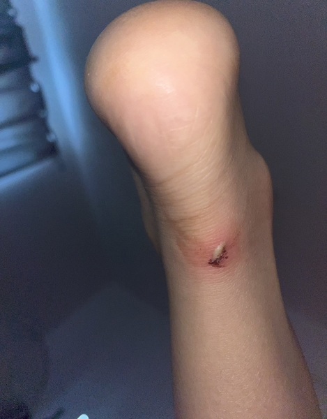 Should I leave it or get medical help? *warning, pics*