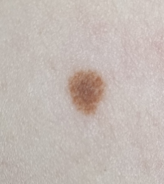 Does DDs mole need to be checked?