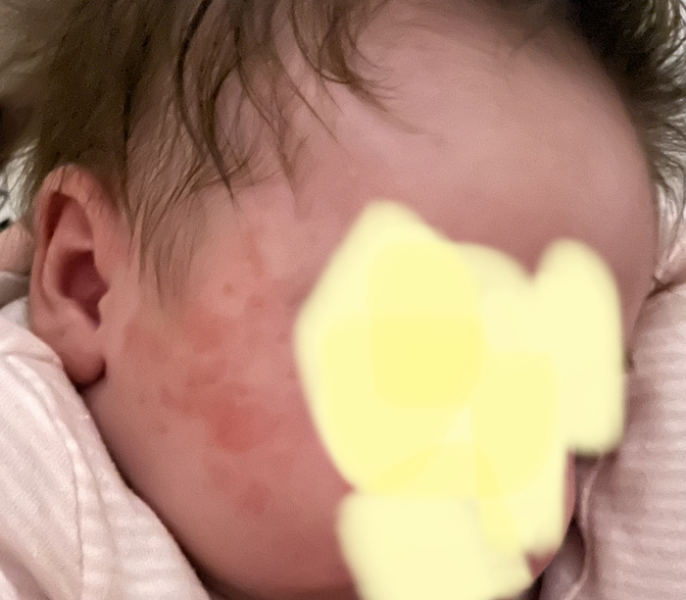 Milk intolerance/allergy help:(? 
