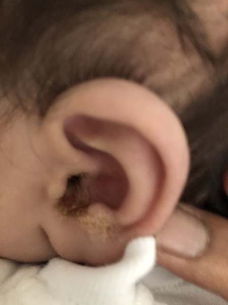 5 month leaky ear