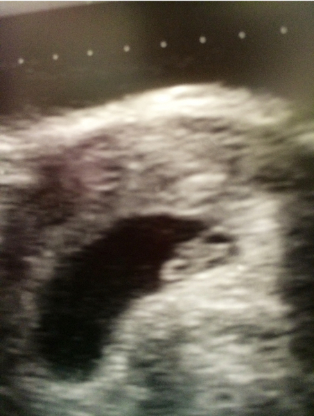 I think I'm close to 5th miscarriage in a row.  No children yet. Feeling so sad...