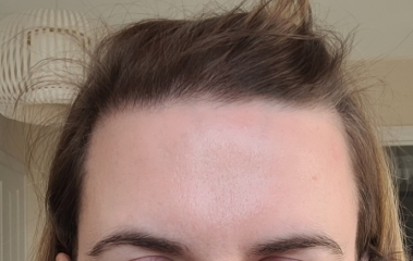 Botox before and after