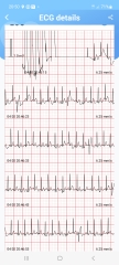 Any nurse/doctors able to interpret ECG?