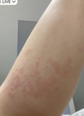 Does this look like dermatitis herpetiformis?