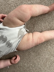 What’s this rash on my 1 year old? 