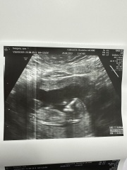 12 weeks ultrasound boy or girl?