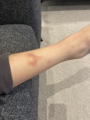 Bruising on child legs with no explanation 