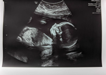 12 week and 20 week scan pictures - Boy or girl? Predictions welcome!