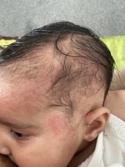 Baby eczema 