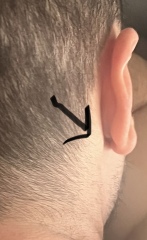 Lump behind partners ear 