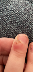 Wart  