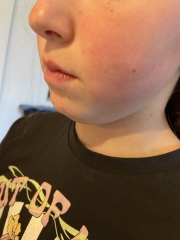 Red cheeks- 11 year old DD