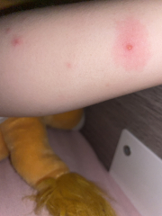 To ask how do you know if chicken pox is infected?