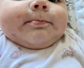 Does this look like impetigo to anyone