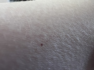 Scabies?!
