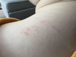 Scabies?!